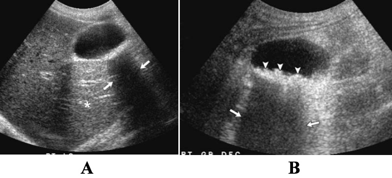 УЗИ: Акустическое затенение УЗИ: Акустическое затенение