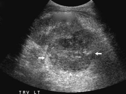 УЗИ: Акустический эффект усиления УЗИ: Акустический эффект усиления