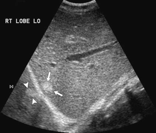 УЗИ: Артефакт «Зеркального изображения» УЗИ: Артефакт «Зеркального изображения»