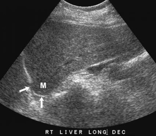 Артефакт скорости звука Артефакт скорости звука