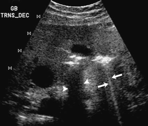 УЗИ: Артефакт множественного отражения УЗИ: Артефакт множественного отражения