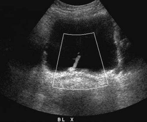 УЗИ мочевого пузыря: струя мочи в мочевом пузыре УЗИ мочевого пузыря: струя мочи в мочевом пузыре