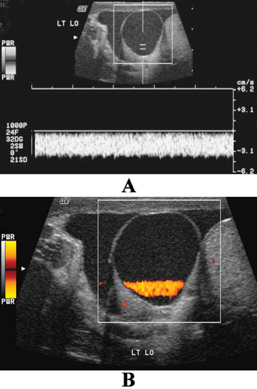 УЗИ органов мошонки: артефакт ложного потока УЗИ органов мошонки: артефакт ложного потока
