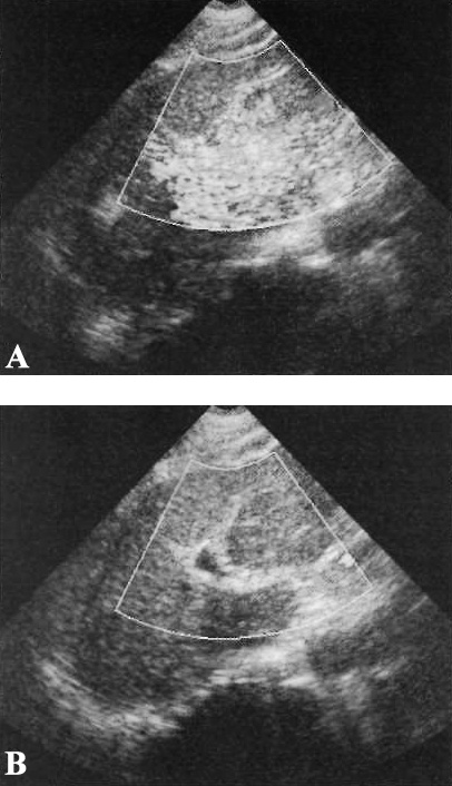 УЗИ: Артефакт вспышки УЗИ: Артефакт вспышки