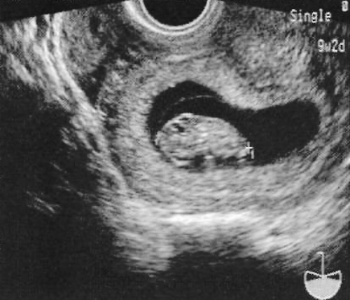 УЗИ: Копчико-теменной размер УЗИ: Копчико-теменной размер