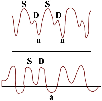 Допплерография: Кровоток в венозном протоке Допплерография: Кровоток в венозном протоке