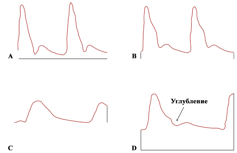 Допплерография маточной артерии Допплерография маточной артерии