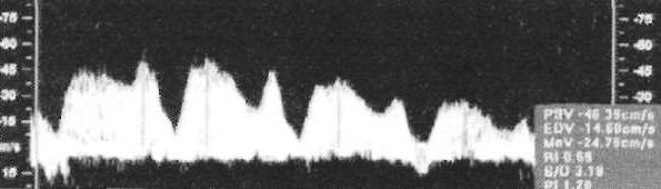 Допплерография: Нормальная волна кровотока в венозном протоке Допплерография: Нормальная волна кровотока в венозном протоке