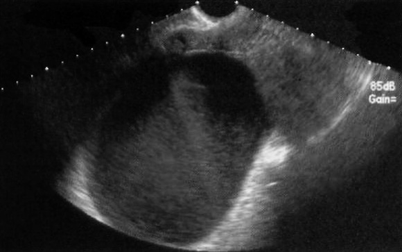 УЗИ: Детрит УЗИ: Детрит