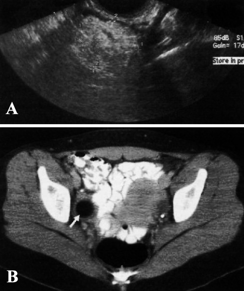 УЗИ: Зрелая кистозная тератома УЗИ: Зрелая кистозная тератома