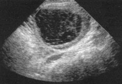 УЗИ: Геморрагическая киста яичника УЗИ: Геморрагическая киста яичника