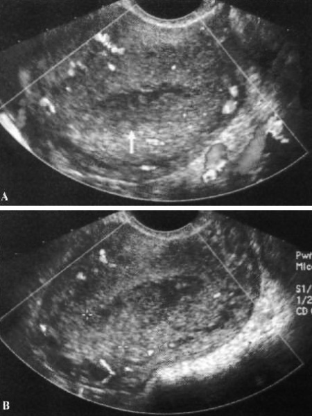 УЗИ: Эндометрит УЗИ: Эндометрит