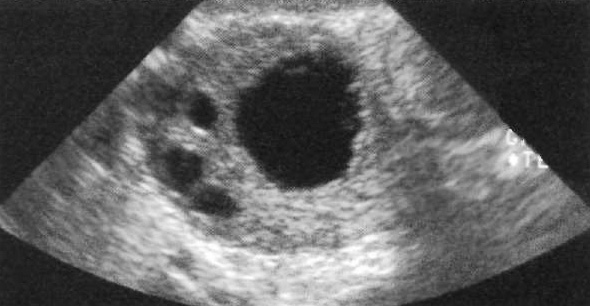 УЗИ: Продольный вид яичника УЗИ: Продольный вид яичника