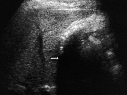 УЗИ: Камни в желчном пузыре УЗИ: Камни в желчном пузыре