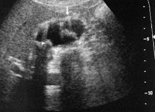 УЗИ: Аденомиоматоз желчного пузыря УЗИ: Аденомиоматоз желчного пузыря