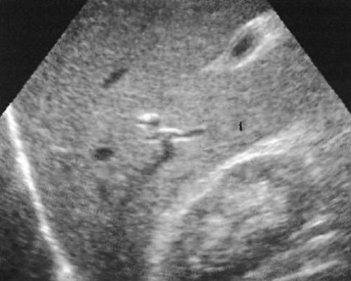 УЗИ: Контрастированный желчный пузырь УЗИ: Контрастированный желчный пузырь