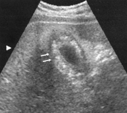 УЗИ: Аденомиоматоз желчного пузыря УЗИ: Аденомиоматоз желчного пузыря