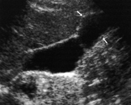 УЗИ: Фригийский колпак УЗИ: Фригийский колпак