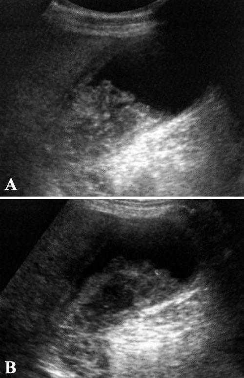 УЗИ: Застой желчи (билиарный сладж) УЗИ: Застой желчи (билиарный сладж)