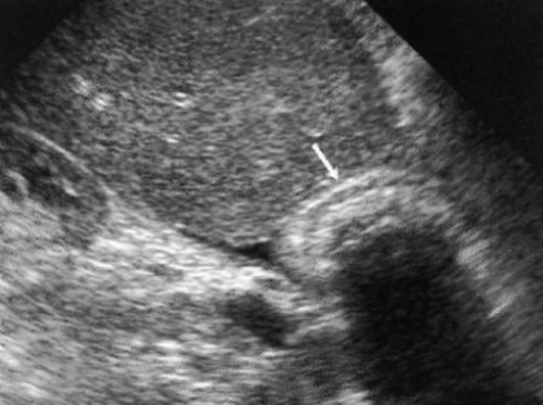 УЗИ: Симптом двойной дуговой тени (триада СЭТ) УЗИ: Симптом двойной дуговой тени (триада СЭТ)