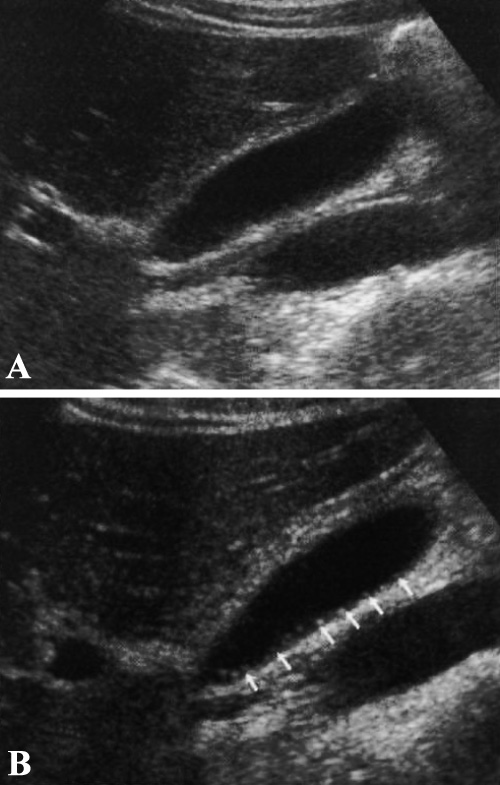 УЗИ: Холелитиаз УЗИ: Холелитиаз