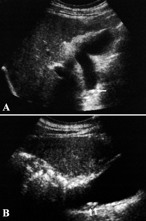 УЗИ: Холелитиаз УЗИ: Холелитиаз
