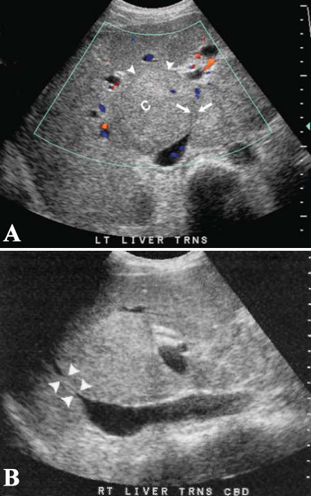 УЗИ: Синдром Бадда-Киари УЗИ: Синдром Бадда-Киари