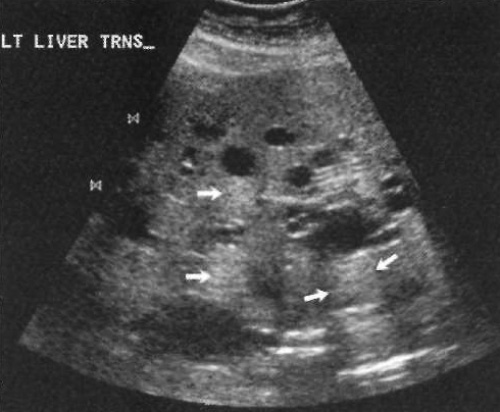 УЗИ: Поликистоз печени УЗИ: Поликистоз печени