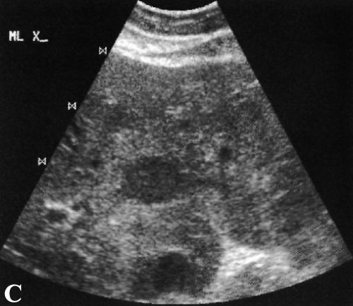 УЗИ: Гепатоцеллюлярная карцинома УЗИ: Гепатоцеллюлярная карцинома