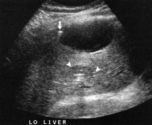 УЗИ: Абсцесс печени УЗИ: Абсцесс печени