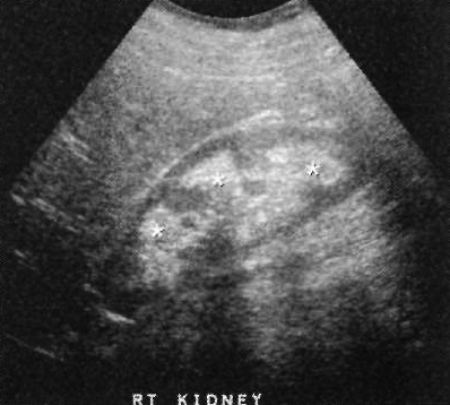 УЗИ: Мозговой нефрокальциноз УЗИ: Мозговой нефрокальциноз