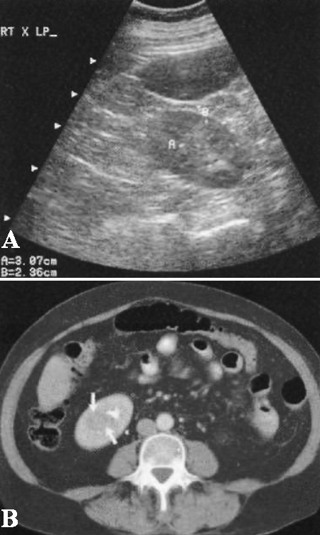 УЗИ: Пиелонефрит УЗИ: Пиелонефрит