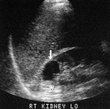 УЗИ: Киста почки УЗИ: Киста почки