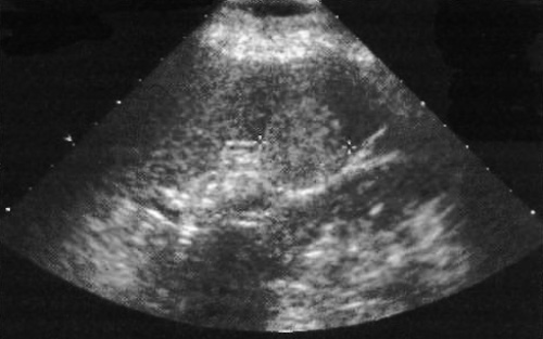 Гемангиома селезенки Гемангиома селезенки