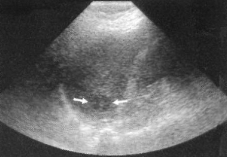 Грибковый абсцесс селезенки Грибковый абсцесс селезенки