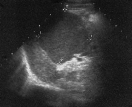 Геморрагическая киста селезенки Геморрагическая киста селезенки
