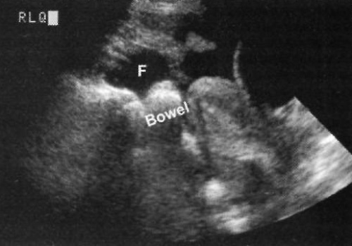 УЗИ: Жидкость в правом нижнем квадранте живота УЗИ: Жидкость в правом нижнем квадранте живота