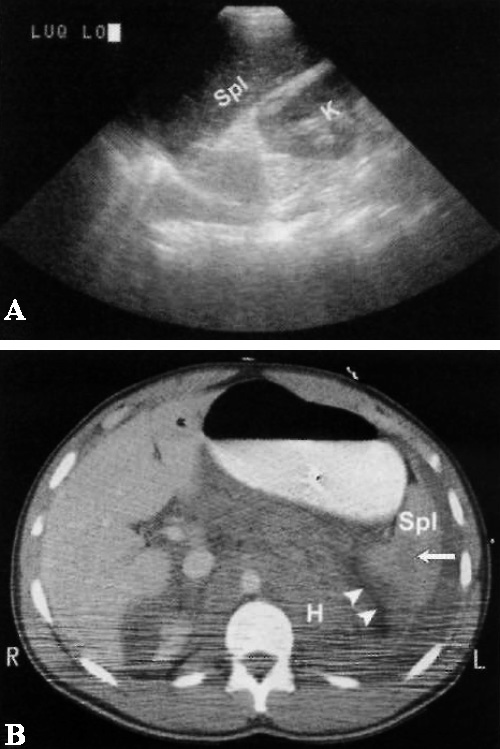 Ложноотрицательное УЗИ Ложноотрицательное УЗИ