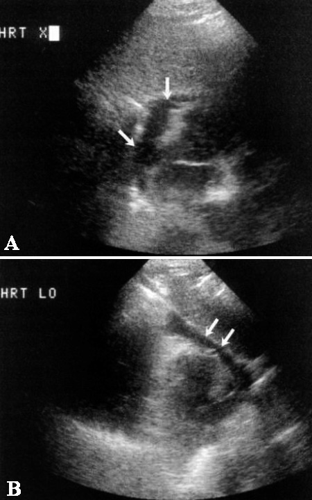 УЗИ: Перикардиальная жидкость УЗИ: Перикардиальная жидкость