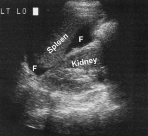 УЗИ: Жидкость в левом верхнем квадранте живота УЗИ: Жидкость в левом верхнем квадранте живота