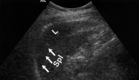 Ложноположительный результат УЗИ Ложноположительный результат УЗИ