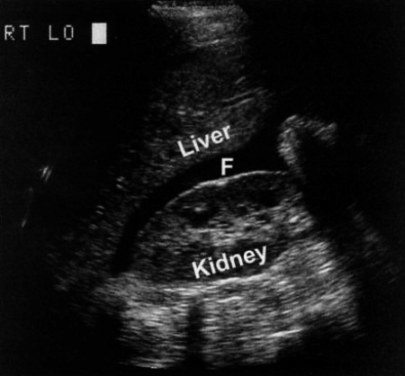 УЗИ: Жидкость в правом верхнем квадранте живота УЗИ: Жидкость в правом верхнем квадранте живота