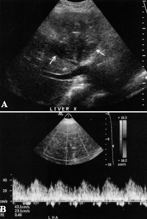 УЗИ: Инфаркт печени УЗИ: Инфаркт печени