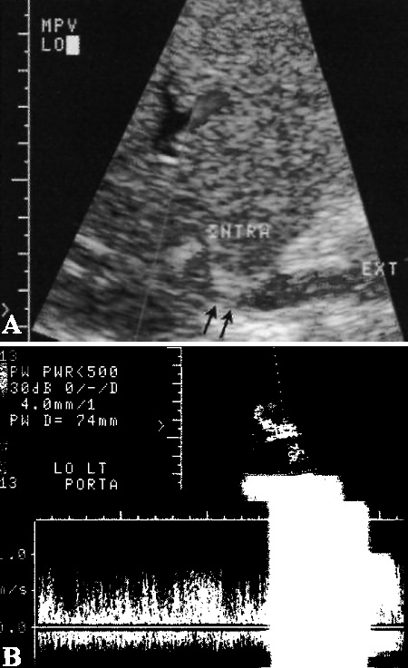 УЗИ: Стеноз воротной вены УЗИ: Стеноз воротной вены