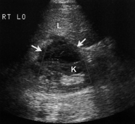 УЗИ: Посттрансплантационное лимфопролиферативное заболевание УЗИ: Посттрансплантационное лимфопролиферативное заболевание