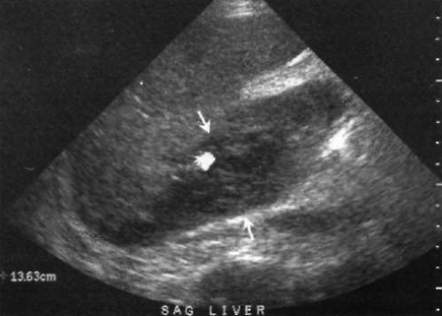 УЗИ: Послеоперационная гематома УЗИ: Послеоперационная гематома