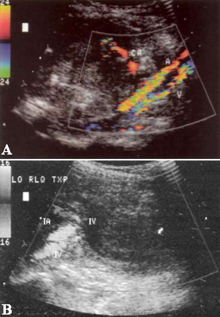 УЗИ: Венозный тромбоз трансплантата поджелудочной железы УЗИ: Венозный тромбоз трансплантата поджелудочной железы