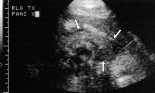 УЗИ: Трансплантат поджелудочной железы УЗИ: Трансплантат поджелудочной железы