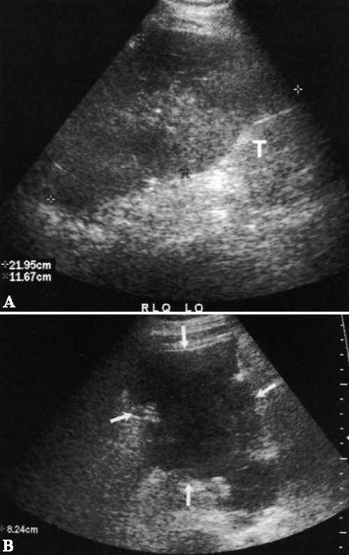 УЗИ: Гематома УЗИ: Гематома