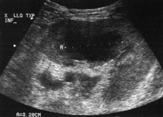 УЗИ: Посттрансплантационное лимфопролиферативное заболевание УЗИ: Посттрансплантационное лимфопролиферативное заболевание